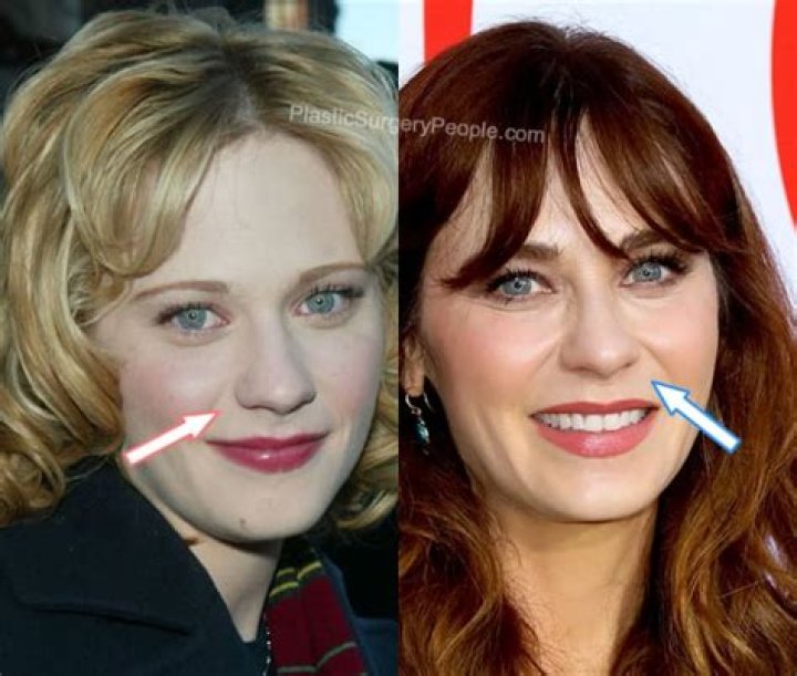 Zooey Deschanel Plastic Surgery: Nose Job, Lip Fillers and What Not?